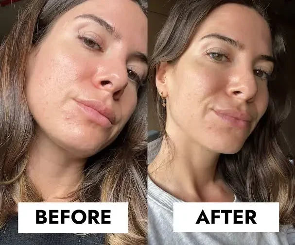 CeraVe Blemish Control Gel Moisturiser with 2% Salicylic Acid &amp; Niacinamide for Blemish-Prone Skin 40ml